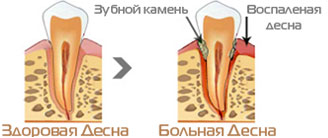 Предотвращение отложения зубного камня